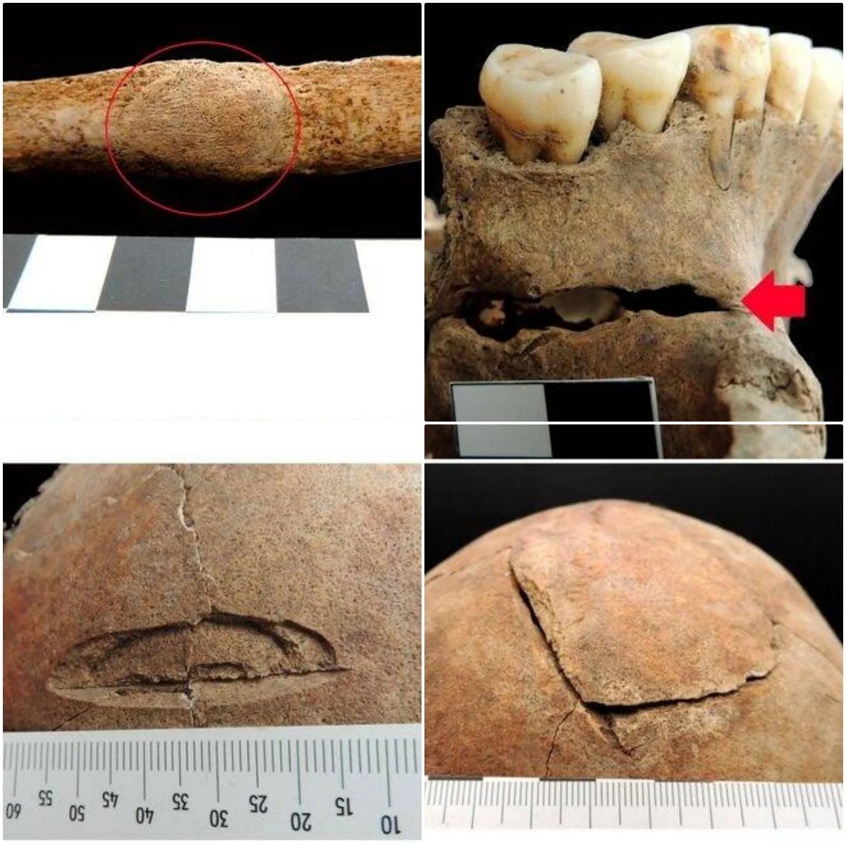 Medieval Burial Unearthed In Croatia That Contains The Decapitated And Contorted Remains Of A Vampire