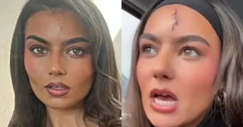 The chilling truth behind the scar Megan (Love Island) tried to hide for years!