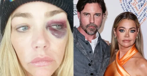 RHOBH Star Denise Richards Exposes Aaron Phypers' Brutal Abuse – Shocking Photos of Injuries & Restraining Order Granted!