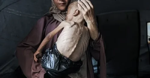 Reducido a piel y huesos en Gaza: La horrible historia detrás de la foto de un niño hambriento con una bolsa de plástico como pañal