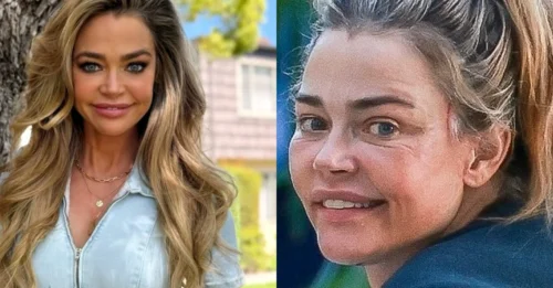 Denise Richards Shocks Fans With Mysterious Marks on Her Face – Internet Convinced She Just Got a Fresh Tune-Up!