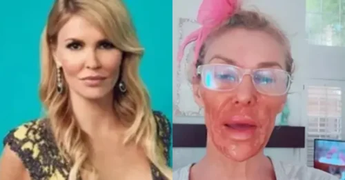 Brandi Glanville’s Face Melted Off in Horrifying Attempt to Kill ‘Flesh-Eating’ Parasite!