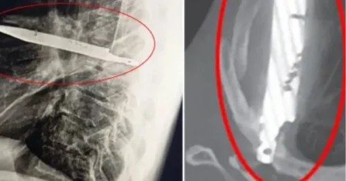 Un hombre se queja de dolor en un pezón y los médicos descubren que tenía un cuchillo gigante alojado en el pecho durante ocho años.