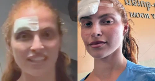 Love Island star suffers gruesome injury as skin torn off in terrifying motorbike crash